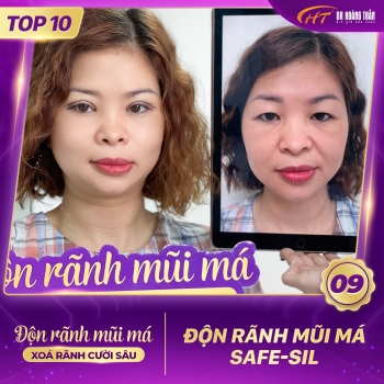 ĐỘN RÃNH MŨI MÁ